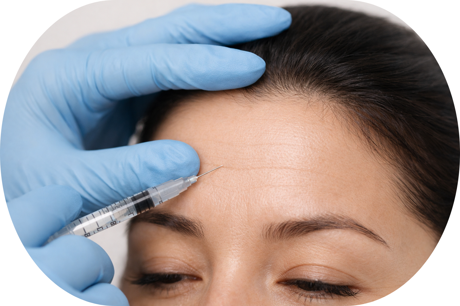 Aplicación de toxina botulínica con fines estéticos